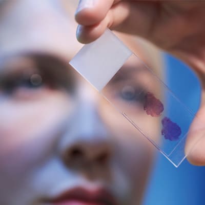 Le moyen de progresser dans les diagnostics et le traitement du cancer