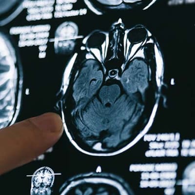 Alzheimer’s disease: no easy answers